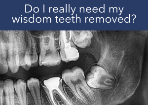 an X-ray showing impacted wisdom teeth/third molars